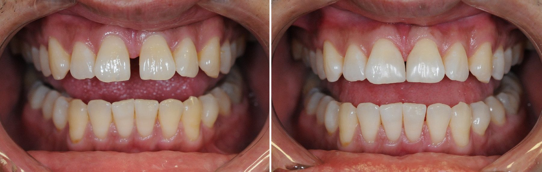 Bonding Case 4 Before & After