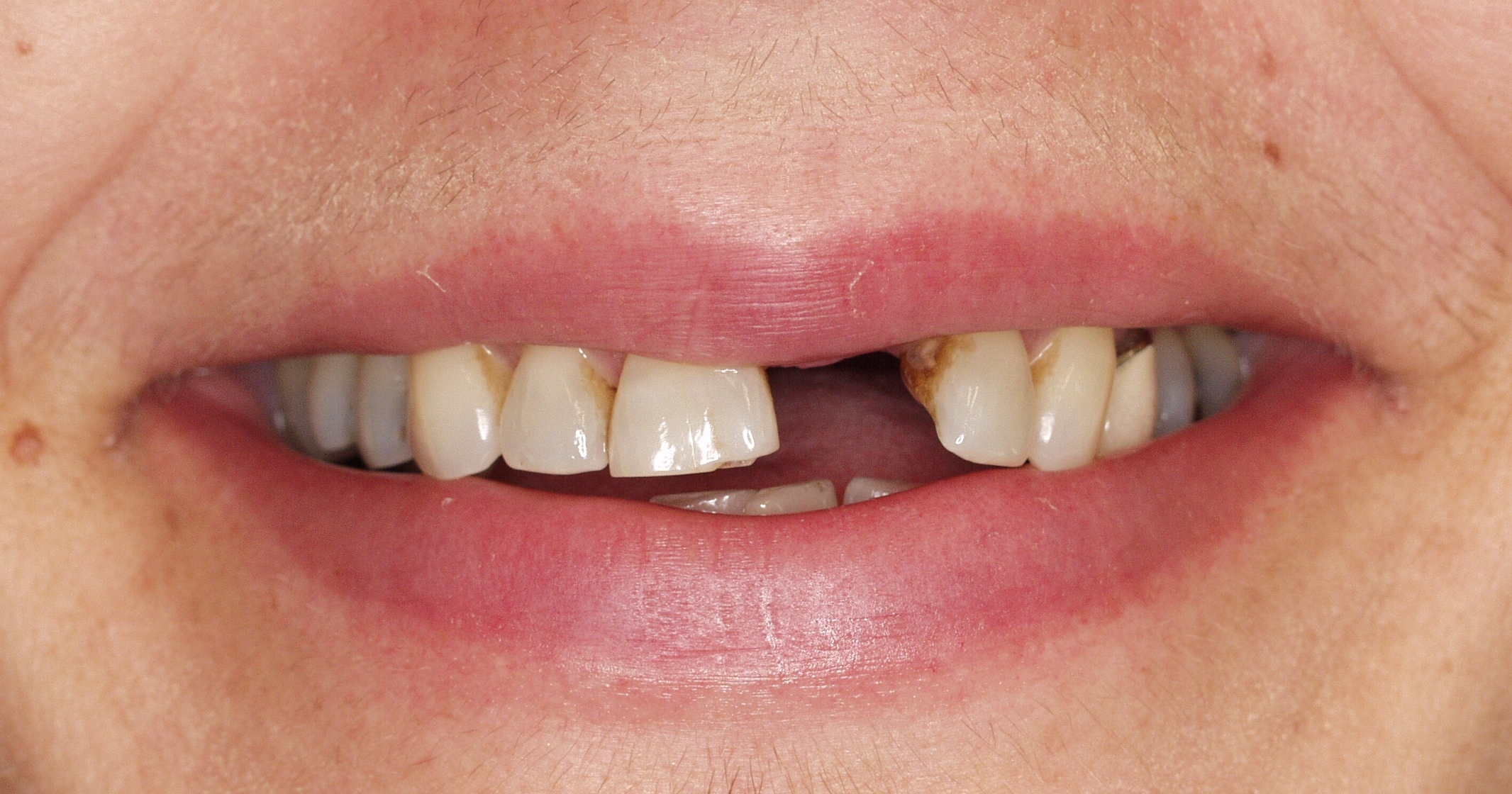 Patient missing one tooth and unhappy with wearing a denture