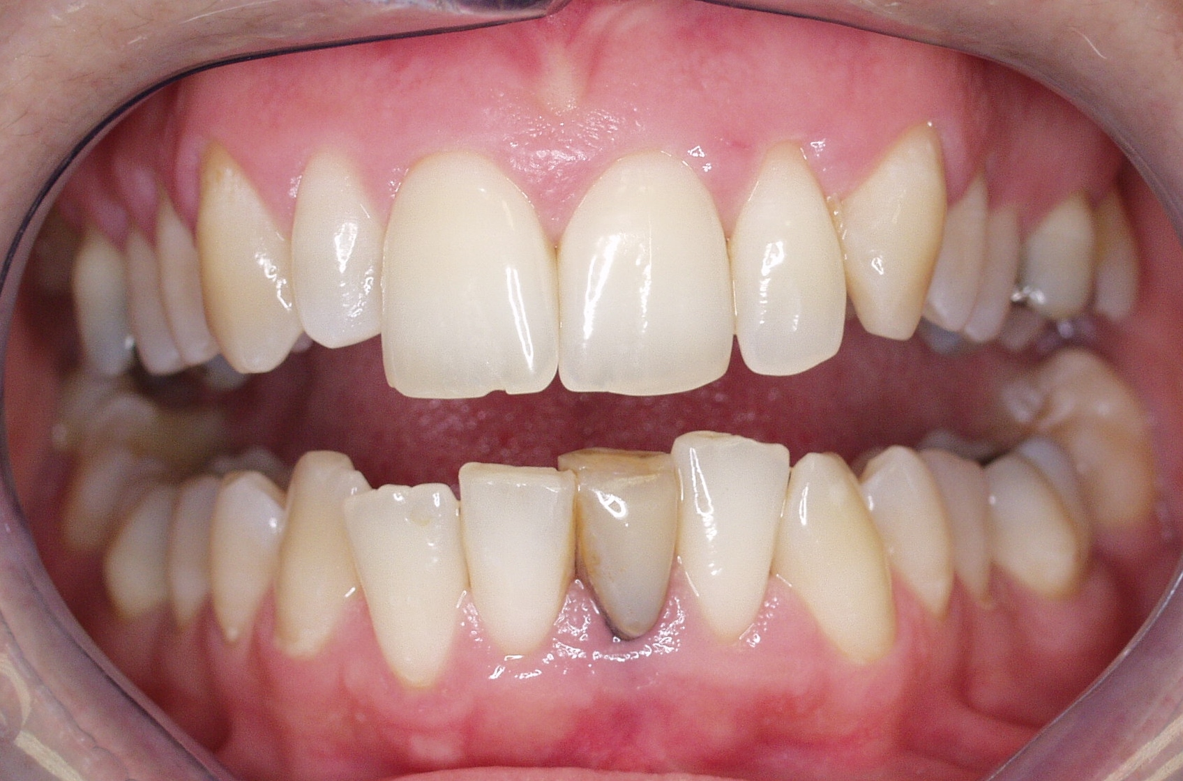 Patient's front lower tooth became damanged beyond repair