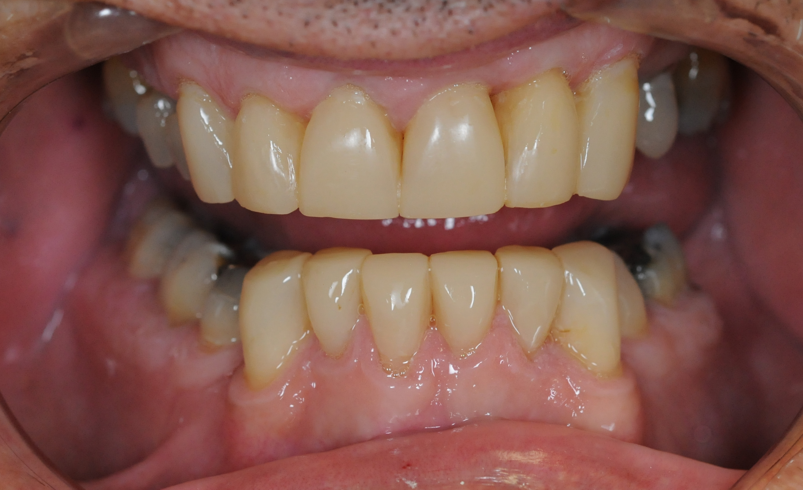Composite and ceramic crowns and bonding