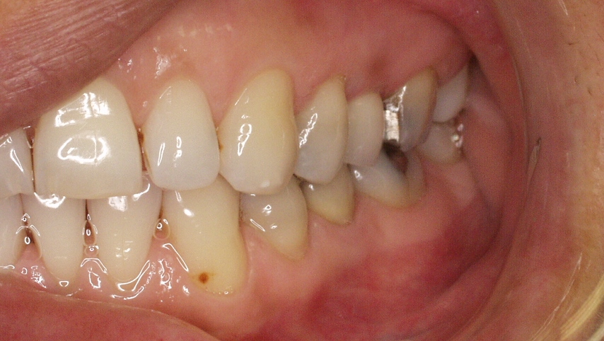 Implant and ceramic crown restoring smile and function