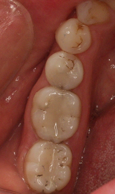 Tooth coloured restorations