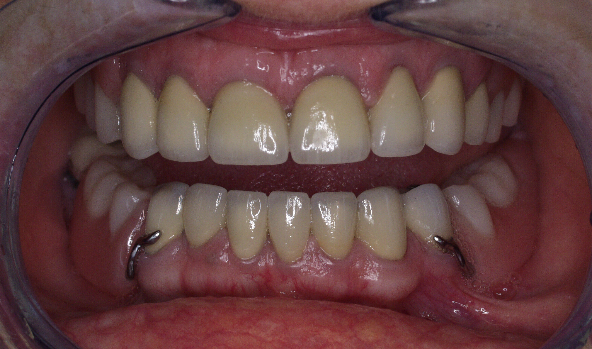 Combination of crowns and bonding
